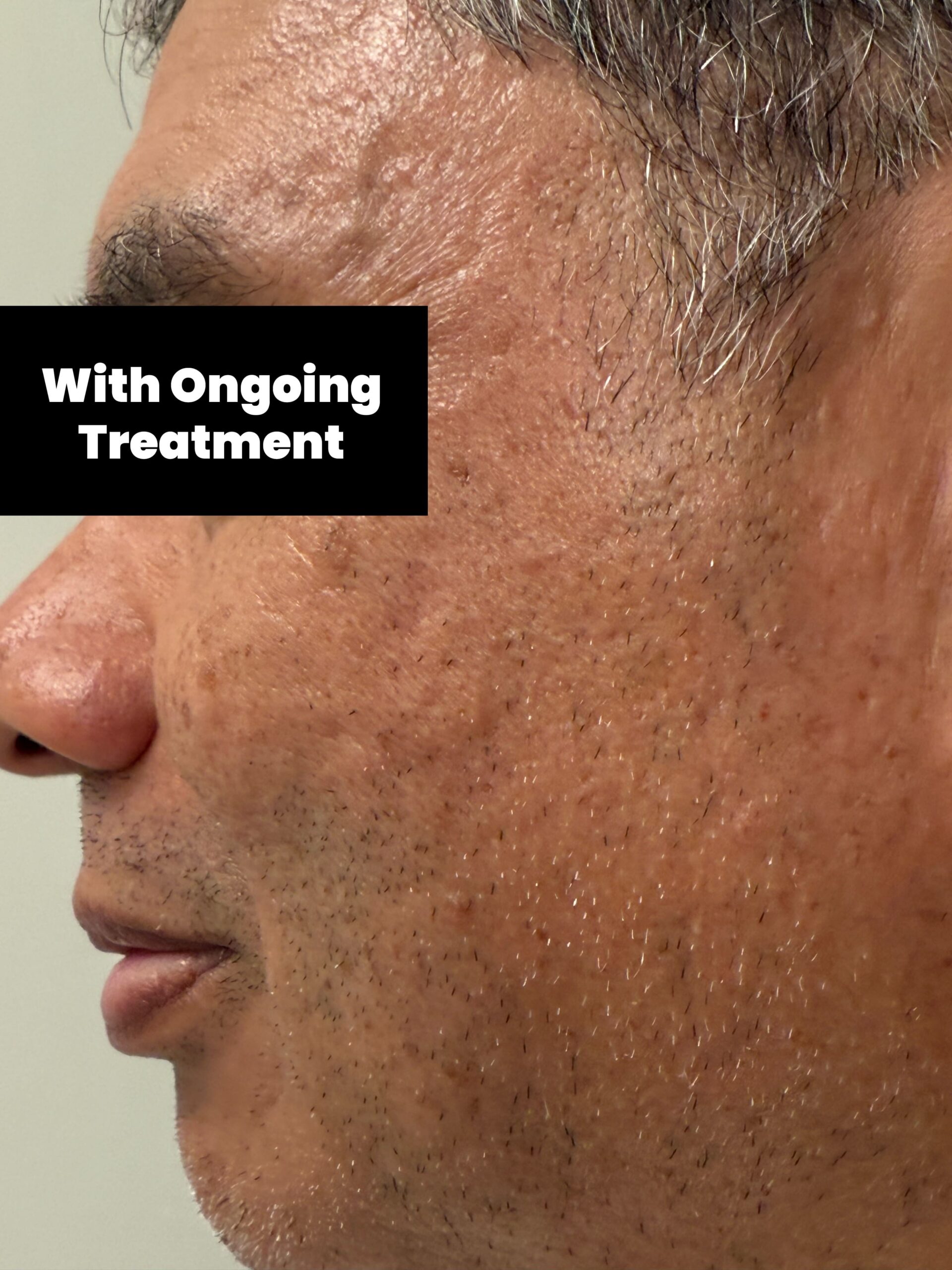 With Ongoing Treatment