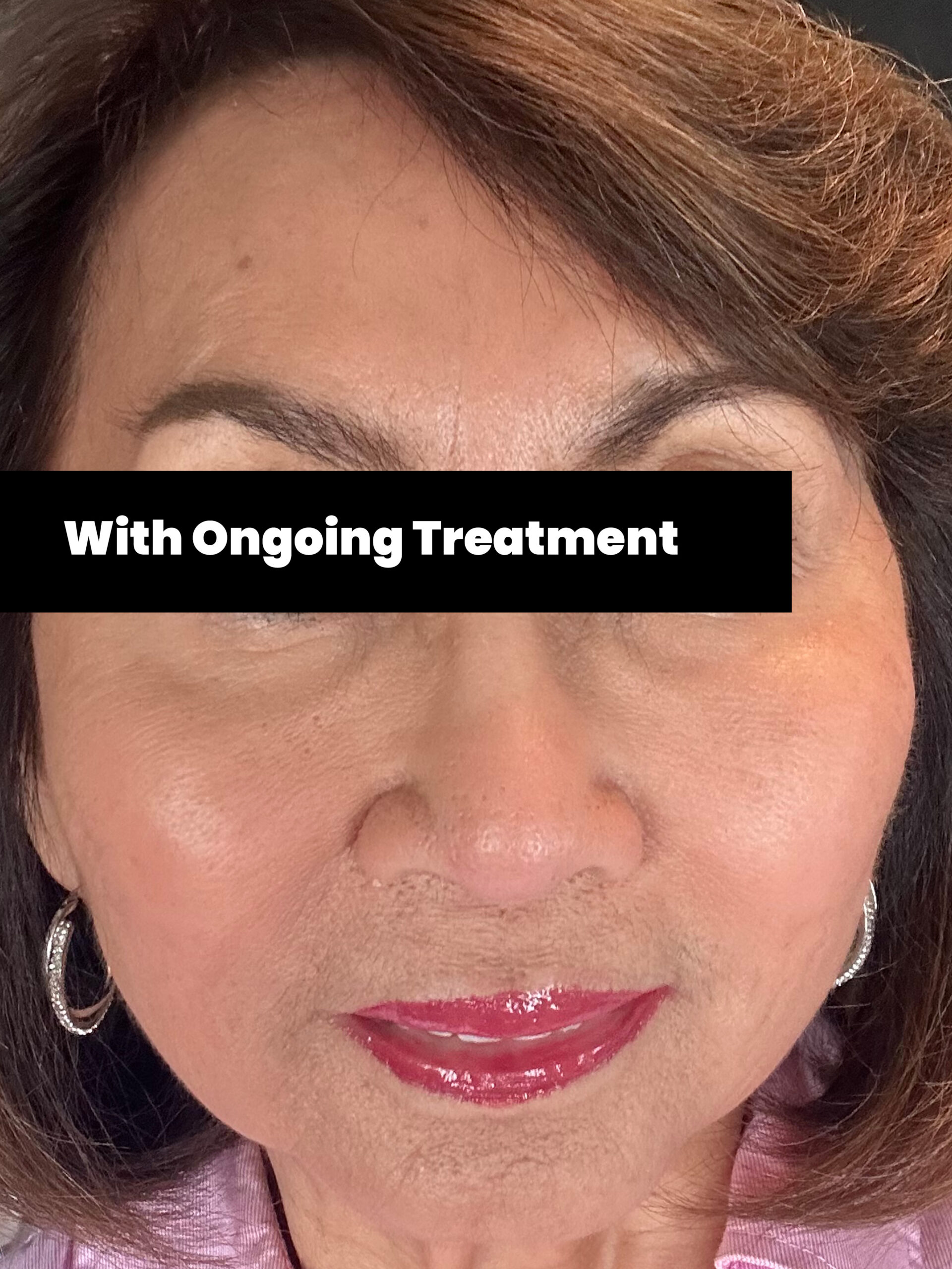 With Ongoing Treatment