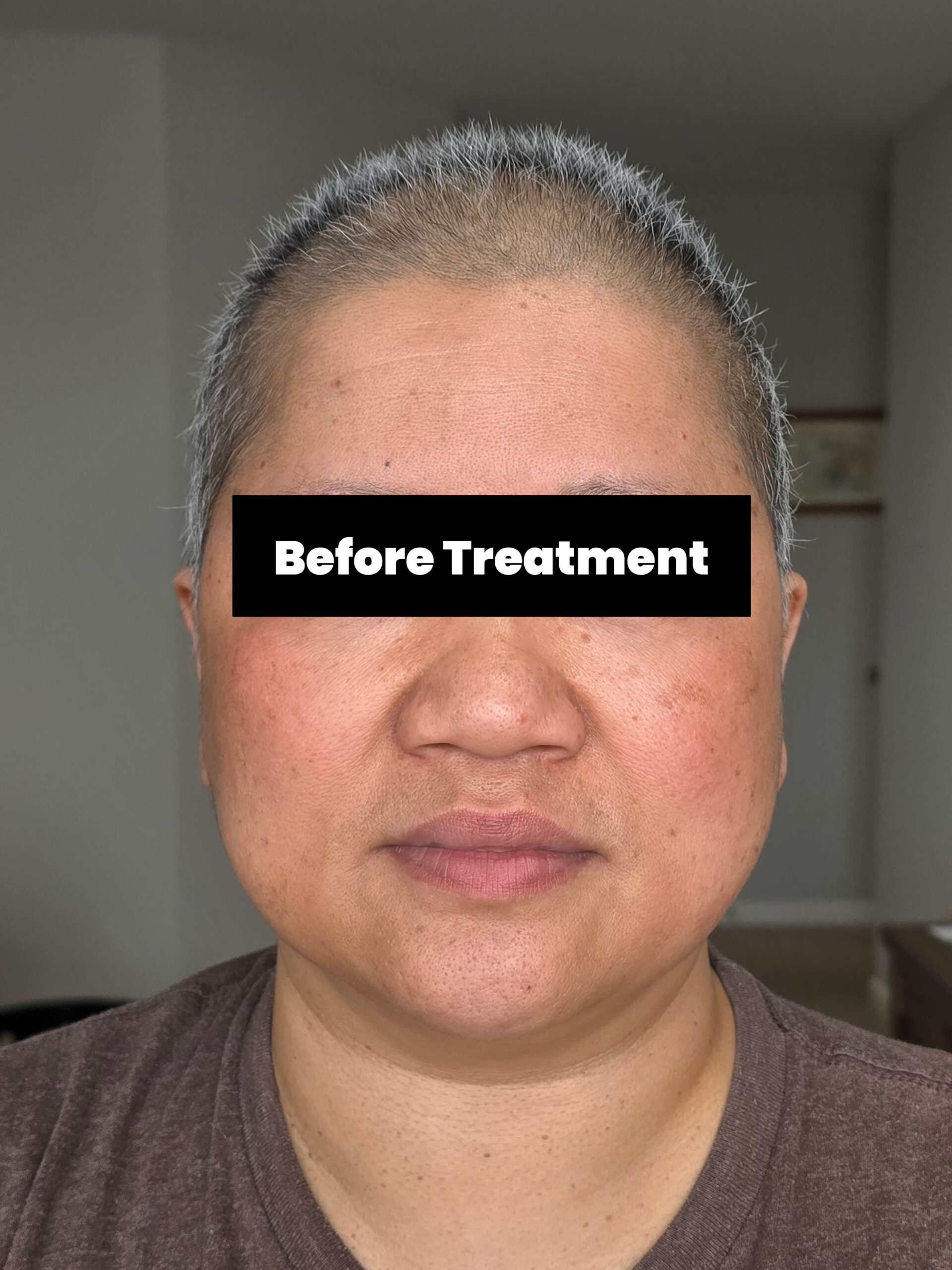 Before Treatment