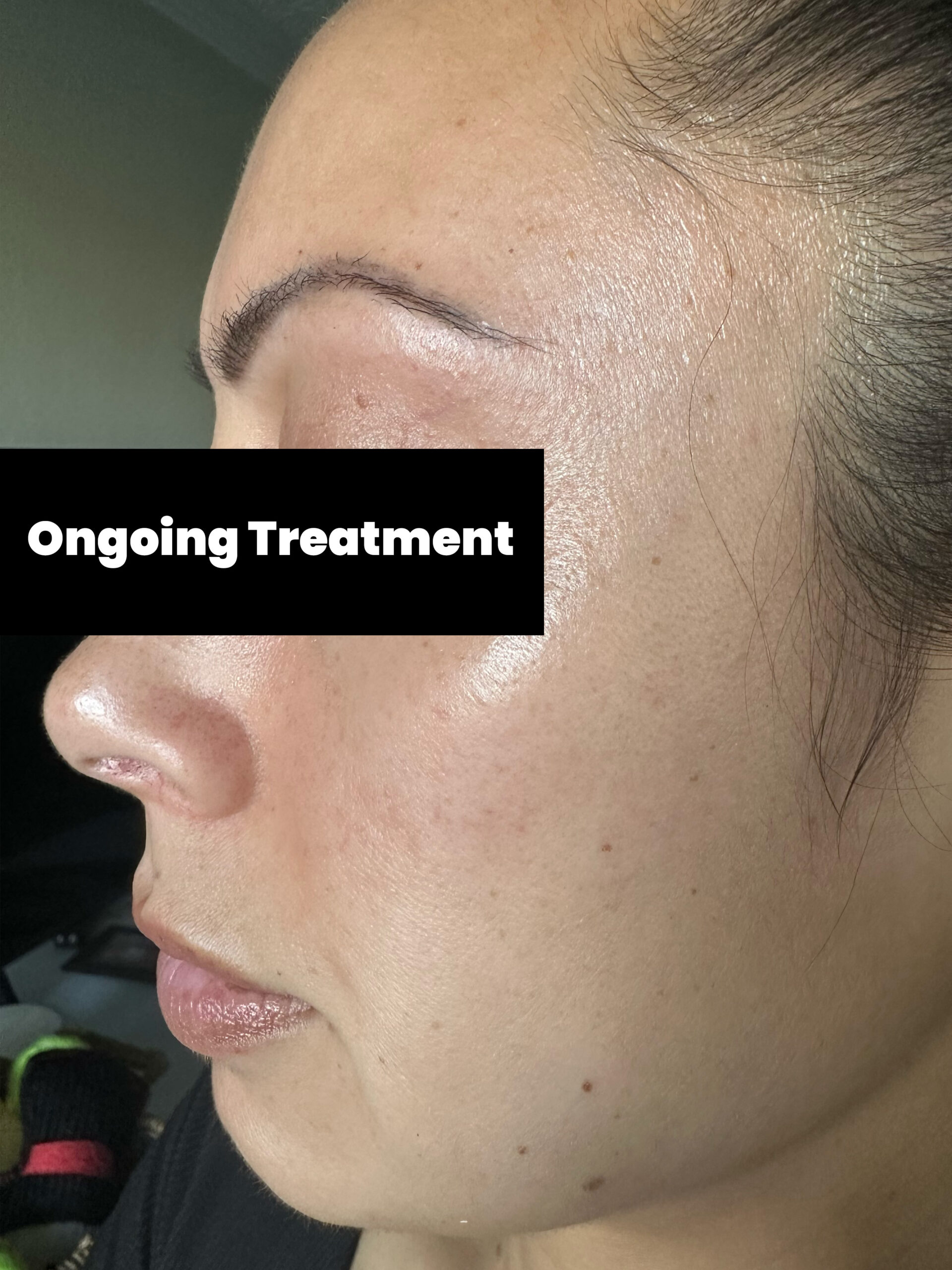 With Ongoing Treatment